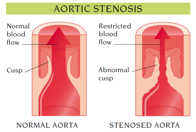 aortic stenosis