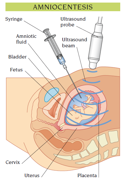 amniocentesis
