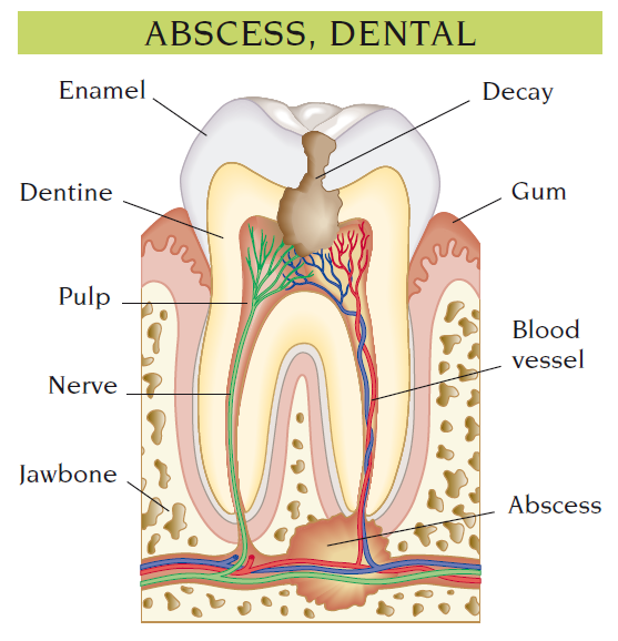 abscess