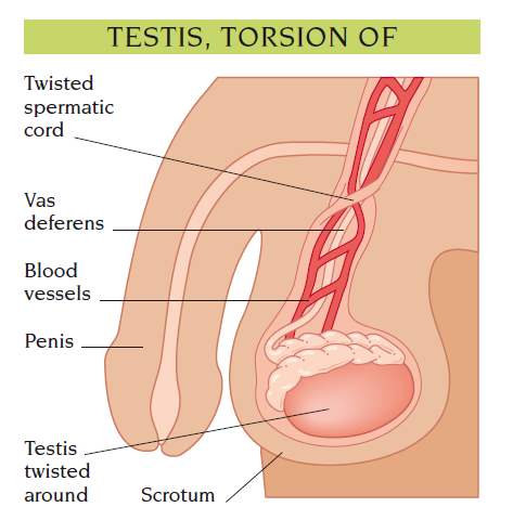 torsion