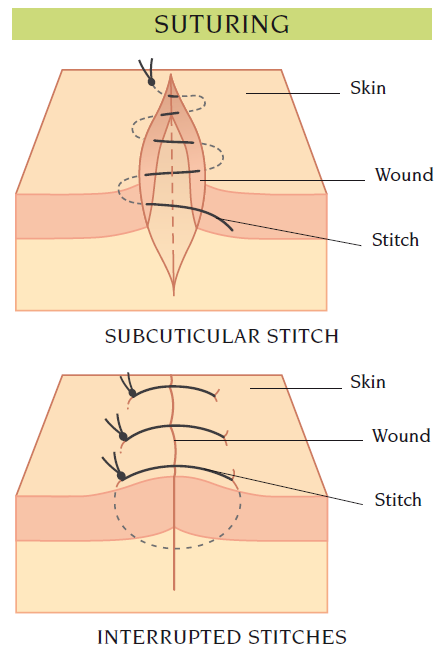 suture