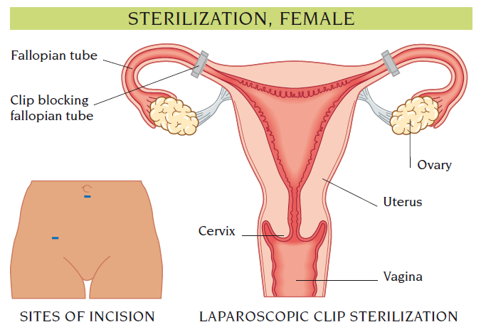 sterilization