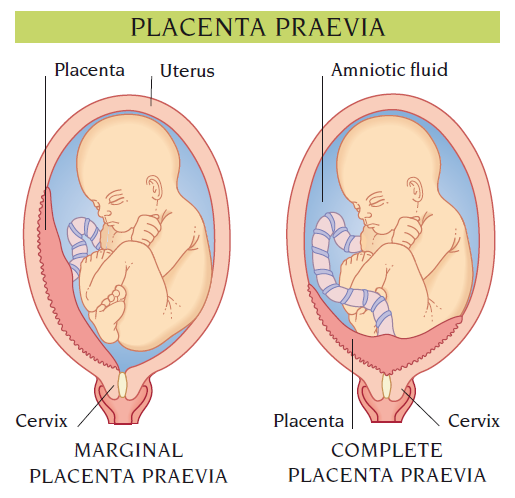 placenta praevia