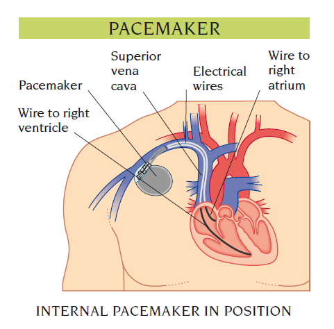 pacemaker