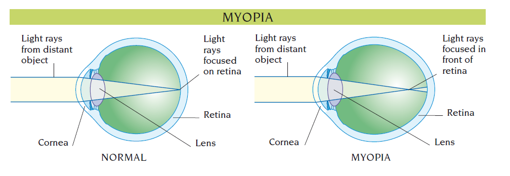 myopia