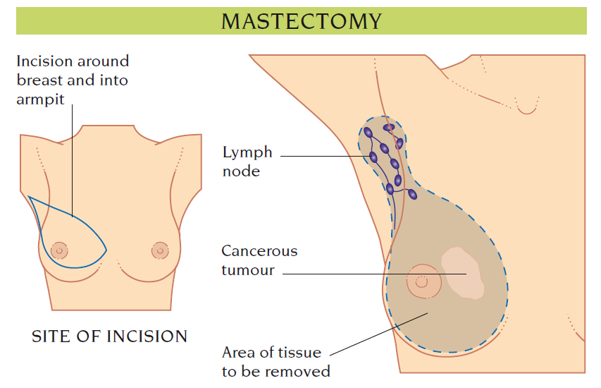 mastectomy