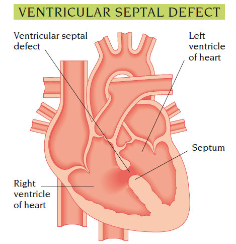ventricular fibrillation