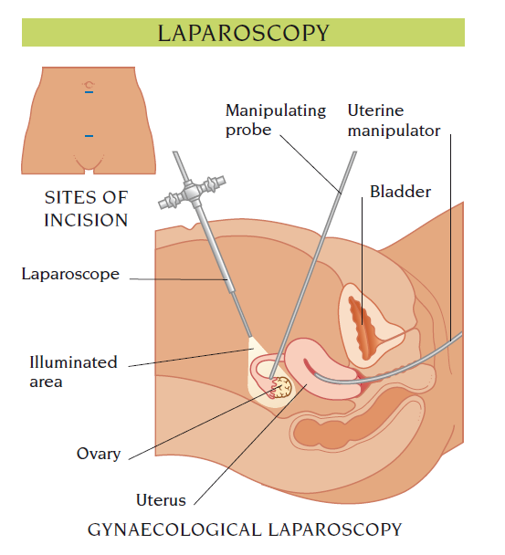 laparoscopy