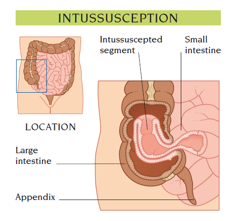 intussusception