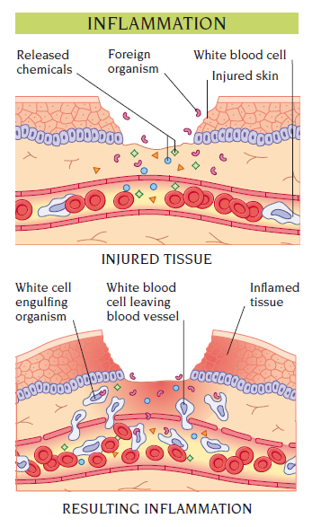inflammation