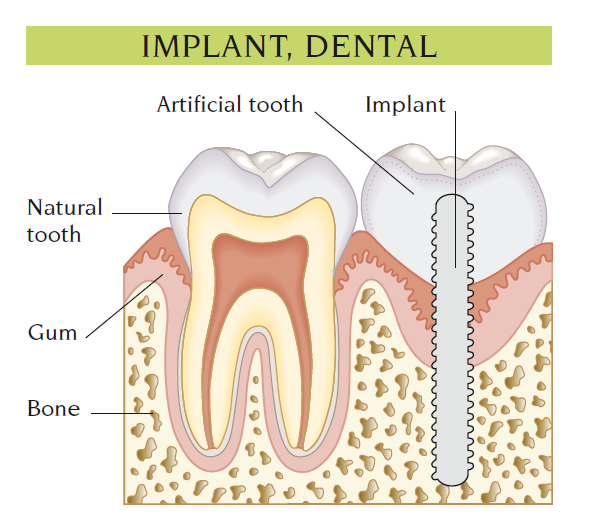 implant
