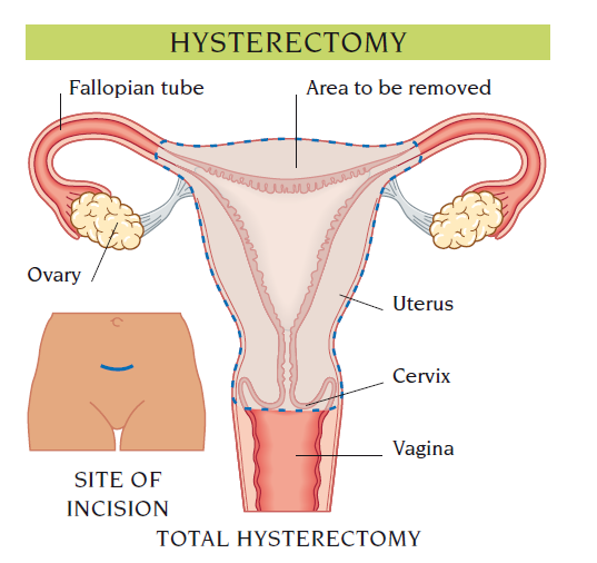 hysterectomy