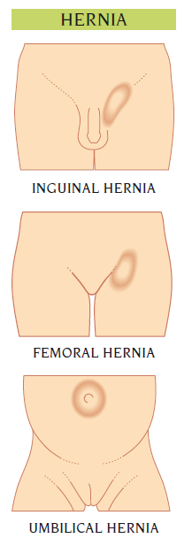 hernia