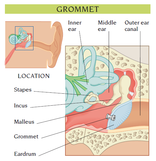 grommet