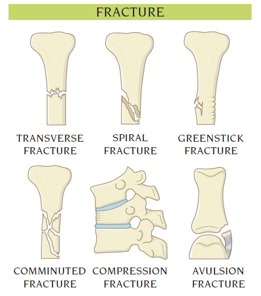 fracture