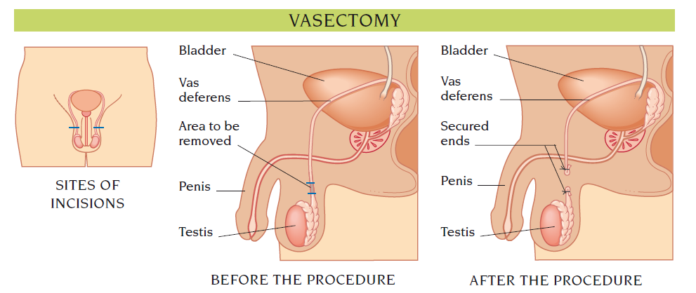 vasectomy