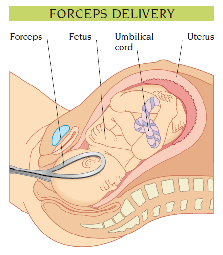 forceps, obstetric