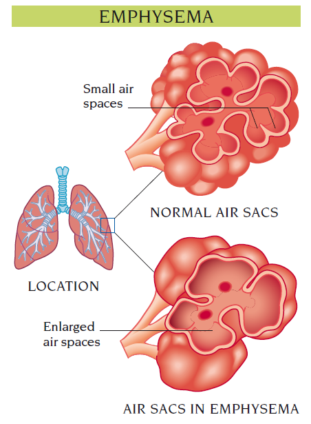 emphysema