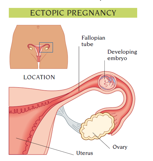 ectopic