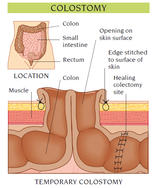 colostomy