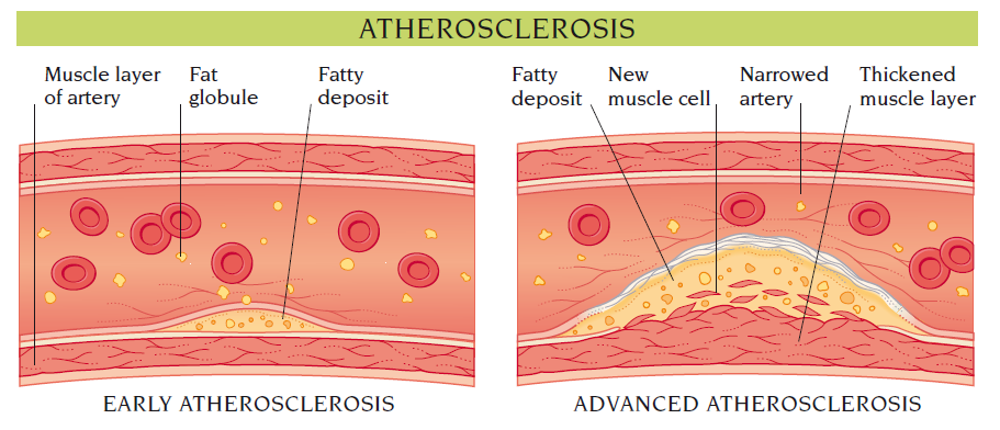 atherosclerosis