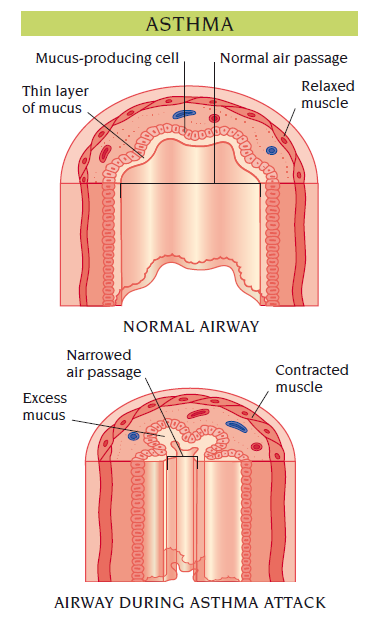 asthma