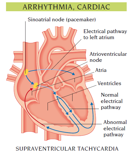 arrhythmia