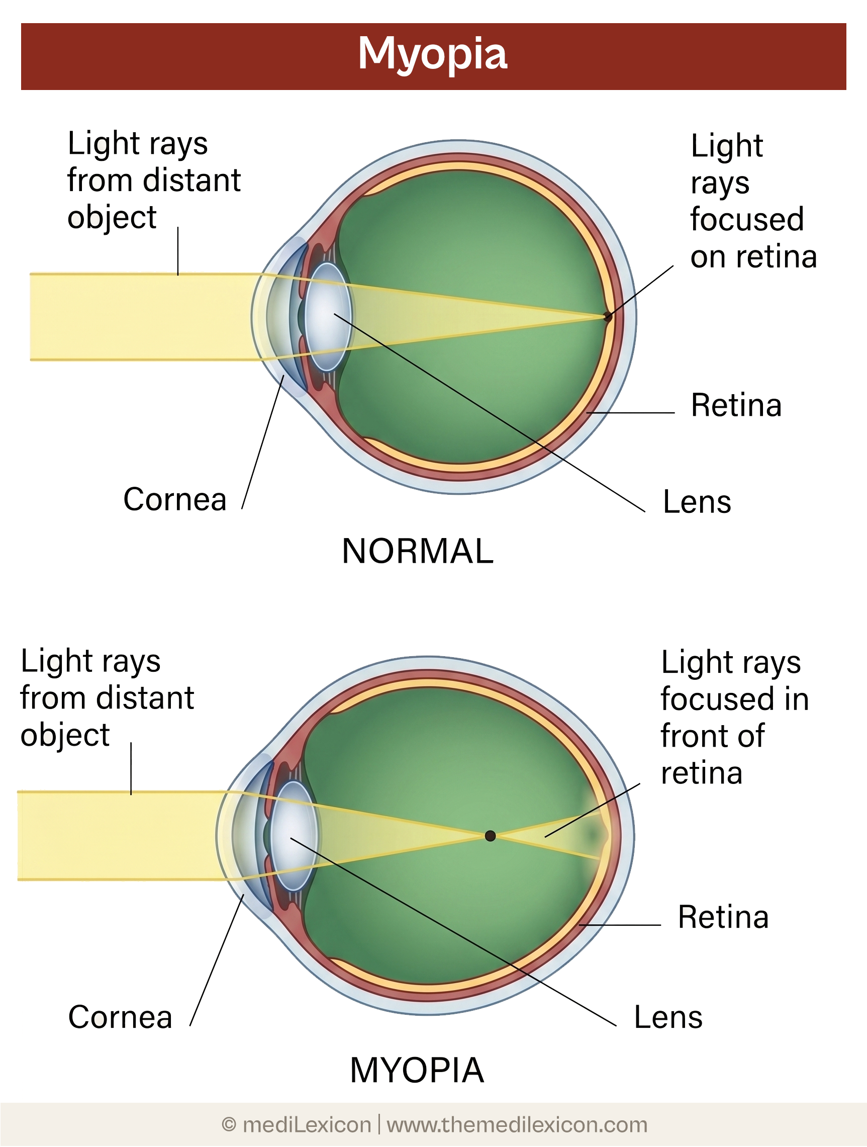 myopia