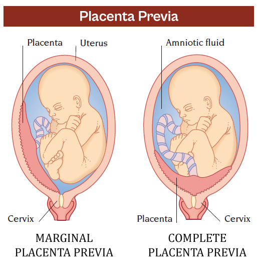 placenta previa